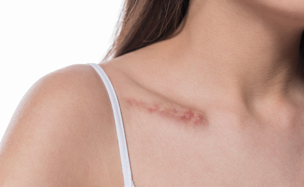 deep tissue massage reduce scars